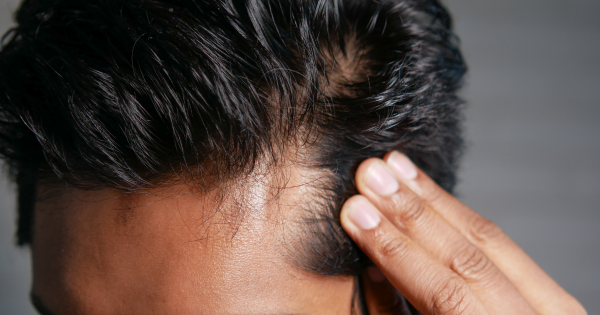 Hair line receding and bald spots 