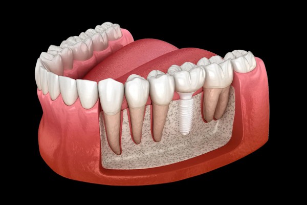 A 3d diagram of a mouth with a dental implant installed