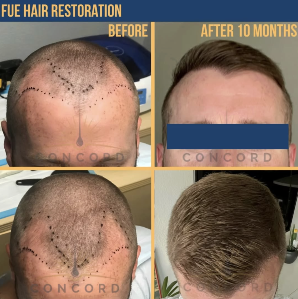 Los Angeles hair transplant expert