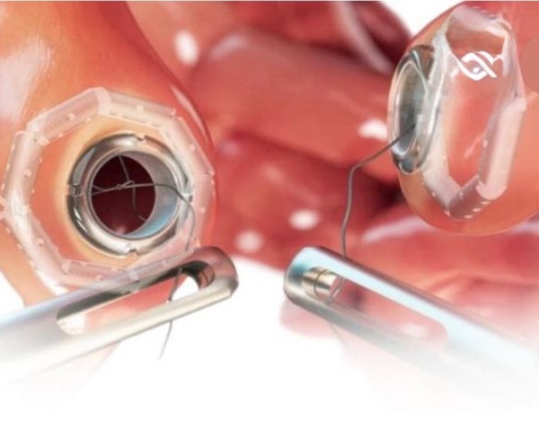 Magnetic Anastomosis May Help Shape the Next Generation of GI Surgery