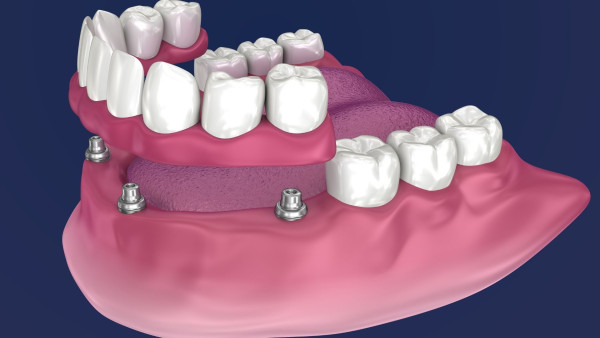 Radiant Smiles Dental Care Receives Excellent Review From Teeth Implants Patient in Perth