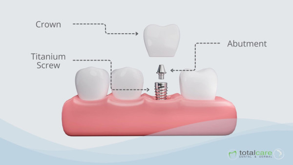 Totalcare Dental and Dermal Now Offers Dental Implants in Sydney