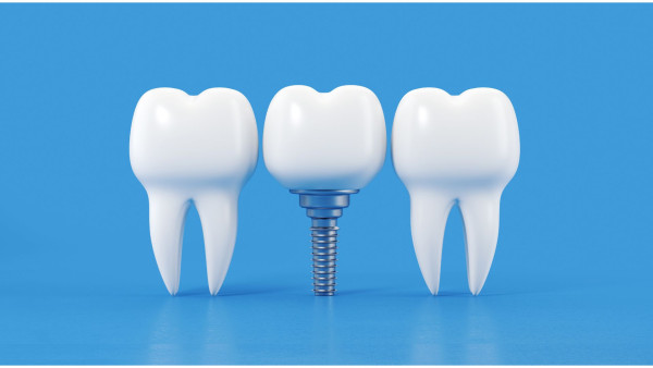 Totalcare Dental and Dermal Now Offers Dental Implants in Sydney