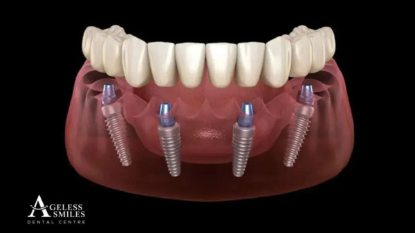 Ageless Smiles Dental Center Announces Enhanced All-on-4 Dental Implants Treatment in Perth