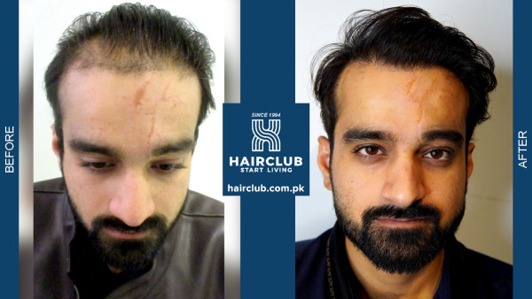 Transforming Lives: Dr. Nasir Rashid and Hair Club Lead the Hair Restoration Industry in Pakistan